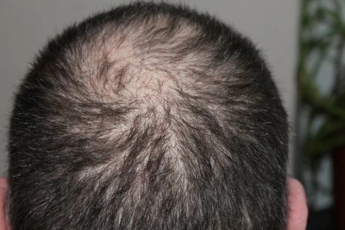 All You Need to Know About Getting a Hair Transplant