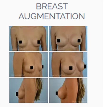 In search of the best breast augmentation surgeon in Orlando