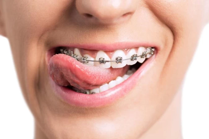 Essential Things You Need to Know About Orthodontic Treatment