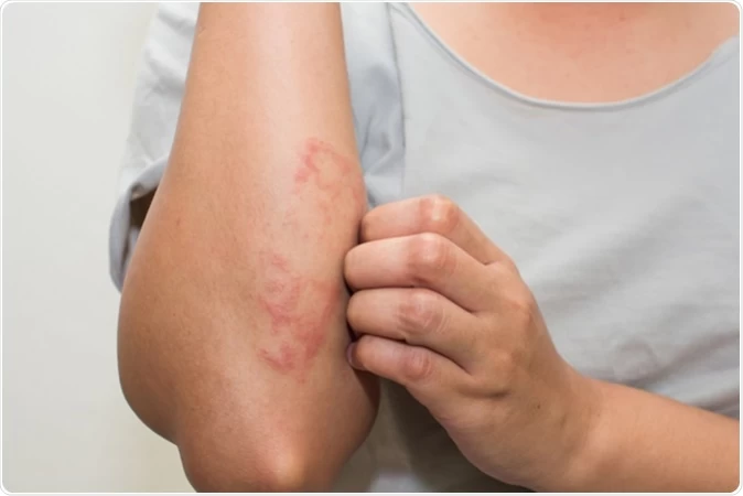 Dermatologist in Jaipur for the Treatment of Eczema| Dr. Sachin Sharda