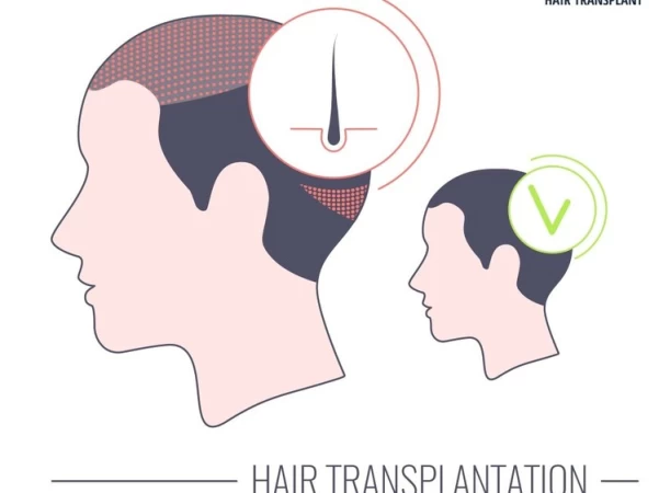 Is Long Hair Transplant Successful? - what is long hair transplant and how it is performed