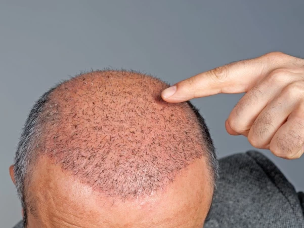Hair Growth After Hair Transplant Surgery