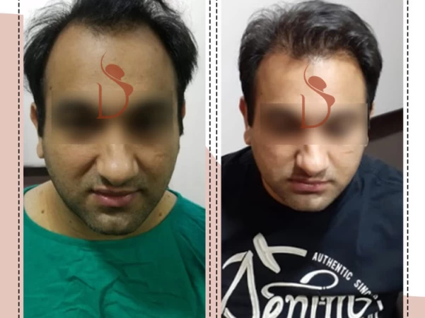 How to Choose the Best Hair Transplant Surgeon in Delhi?