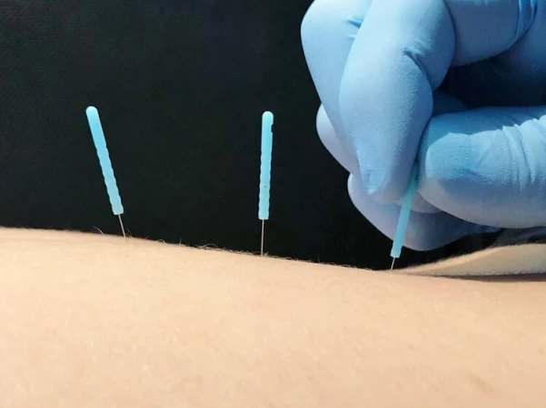 Dry Needling: What it is and why we do it