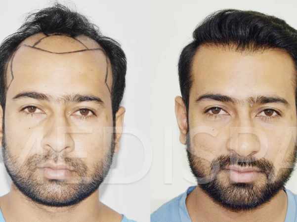 Are You Seeking Hair Restoration? India Beelines You As a Pioneer Hair Transplant Destination